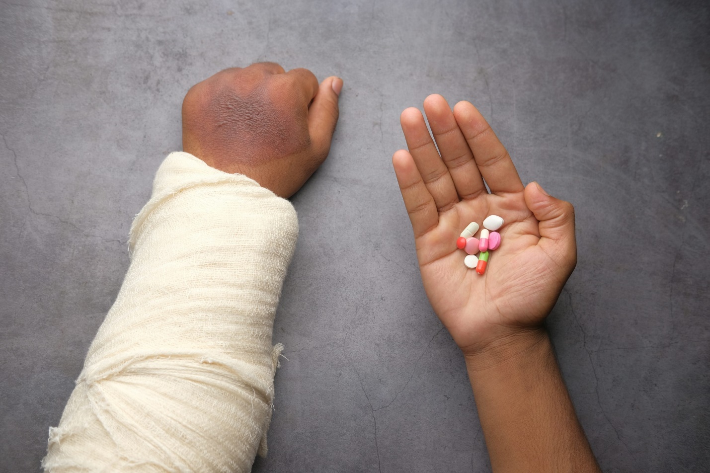 Patient with an arm fracture wearing a cast alongside prescribed medications during recovery from a workplace injury.
